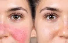 Sandra Dewi Akui Idap Rosacea, Ternyata Ini Penyebabnya!