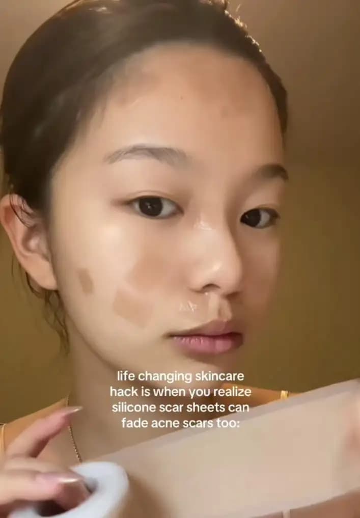 Fakta Plester Silikon Buat Kulit Acne Prone