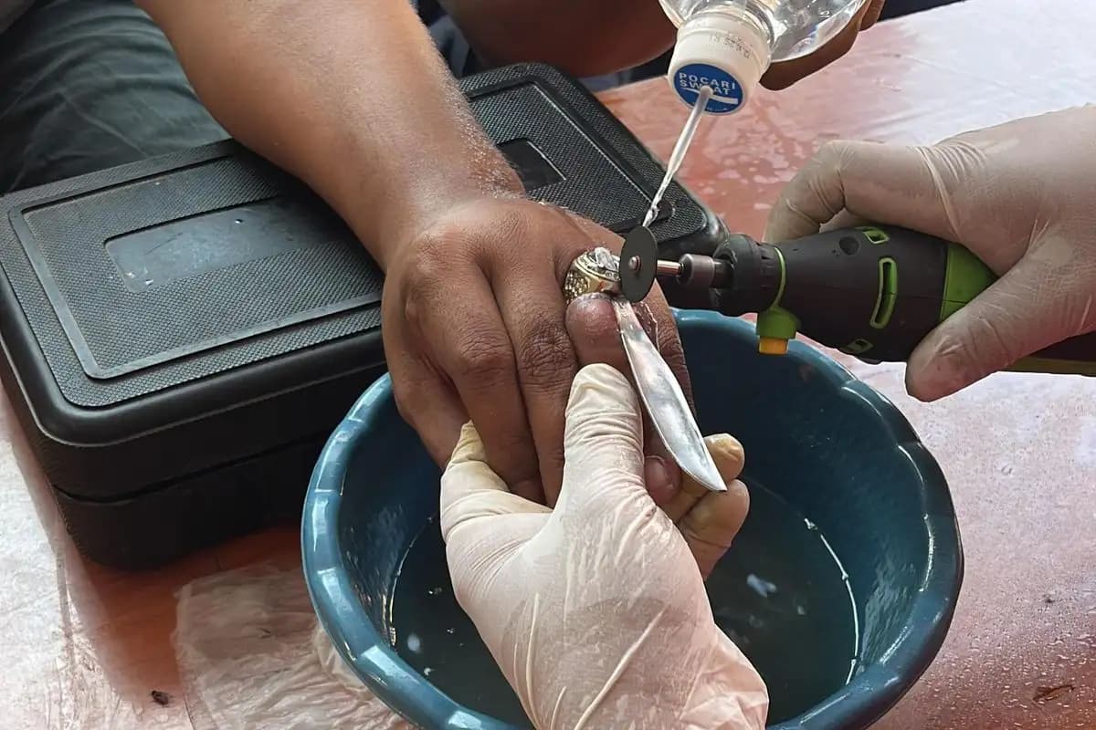 Warga Nganjuk Dibantu Damkar Lepaskan Cincin yang Membuat Jari Bengkak dan Luka  
